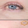 Microblading and Nanobrows for Trichotillomania: An Expert's Perspective