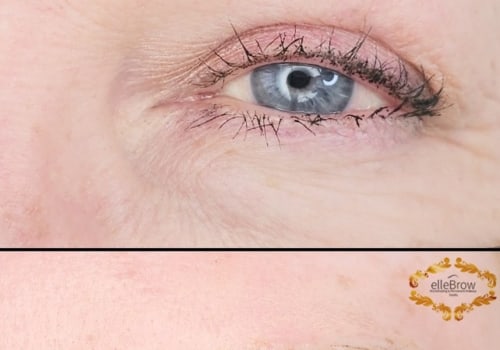 Microblading and Nanobrows for Trichotillomania: An Expert's Perspective